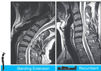 Upright Dynamic MRI Reveals Hidden Disc Herniation