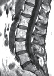 Evaluation of Spinal Instability